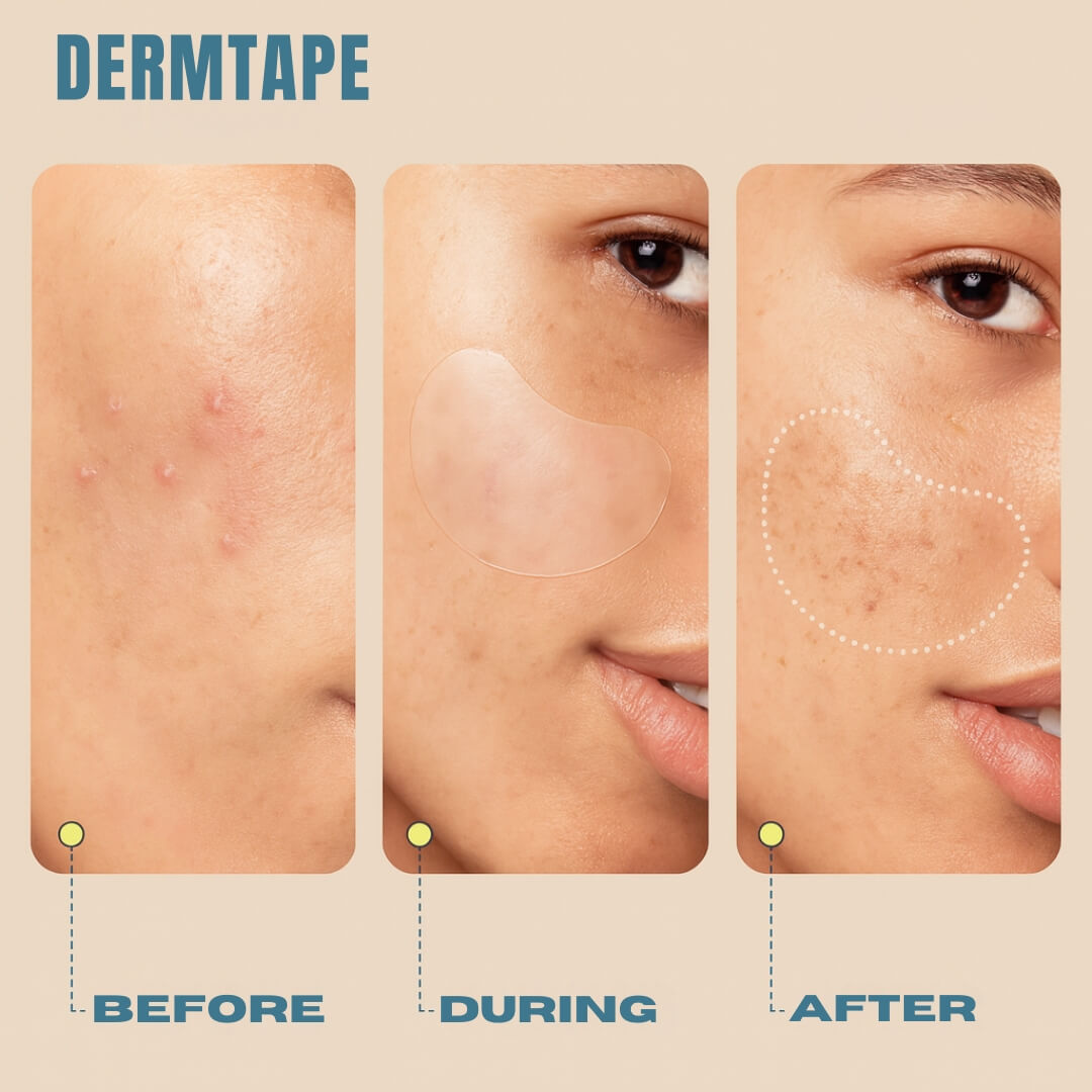DermTape – Hydrocolloid Acne & Scarring Tape Roll